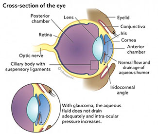 diagram of glaucoma